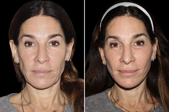 Facelift & Necklift Before and After Photos in CA, Irvine, Patient 4893