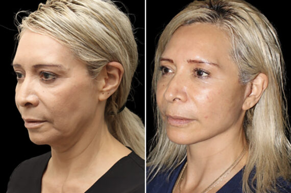 Facelift & Necklift Before and After Photos in CA, Irvine, Patient 4897