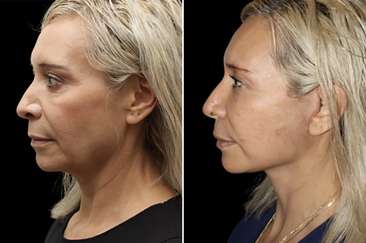 Facelift & Necklift Before and After Photos in CA, Irvine, Patient 4897