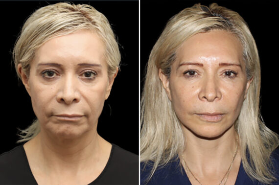 Facelift & Necklift Before and After Photos in CA, Irvine, Patient 4897