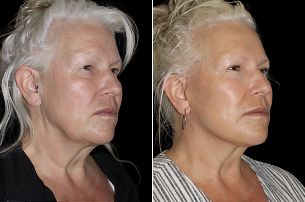 Facelift & Necklift Before and After Photos in CA, Irvine, Patient 4901