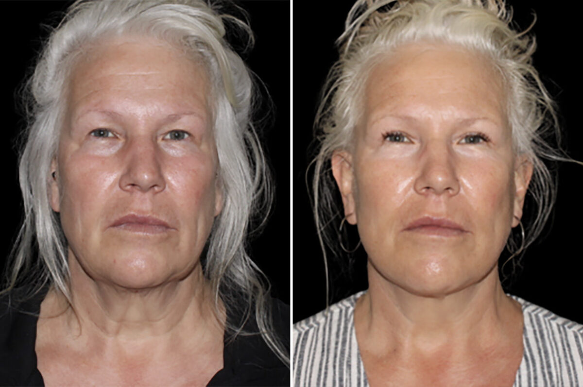Facelift & Necklift Before and After Photos in CA, Irvine, Patient 4901