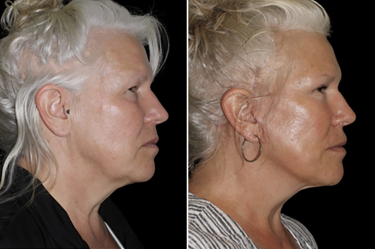 Facelift & Necklift Before and After Photos in CA, Irvine, Patient 4901