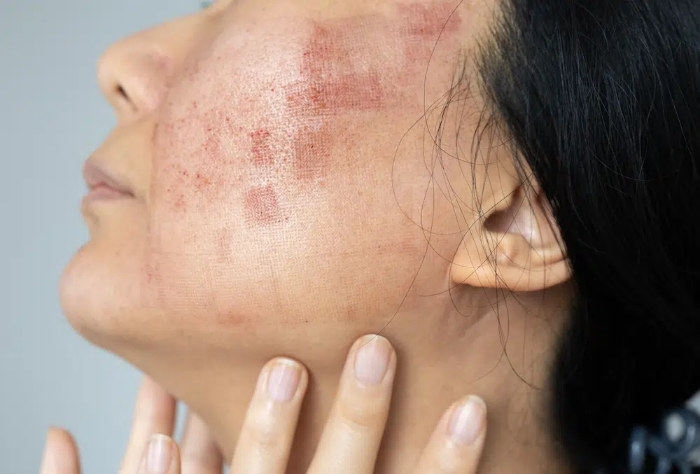 Close-up of woman's face showing redness and irritation immediately after laser skin resurfacing treatment.