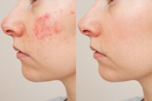 Side-by-side view showing facial redness before and smoother skin after laser resurfacing treatment for healing results.