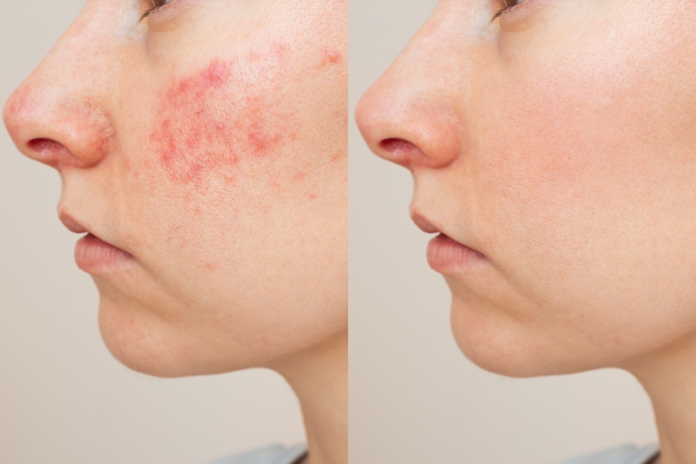 Side-by-side view showing facial redness before and smoother skin after laser resurfacing treatment for healing results.