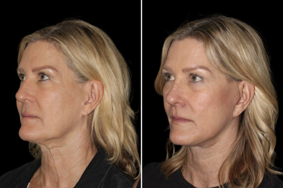 Facelift & Necklift Before and After Photos in CA, Irvine, Patient 5137