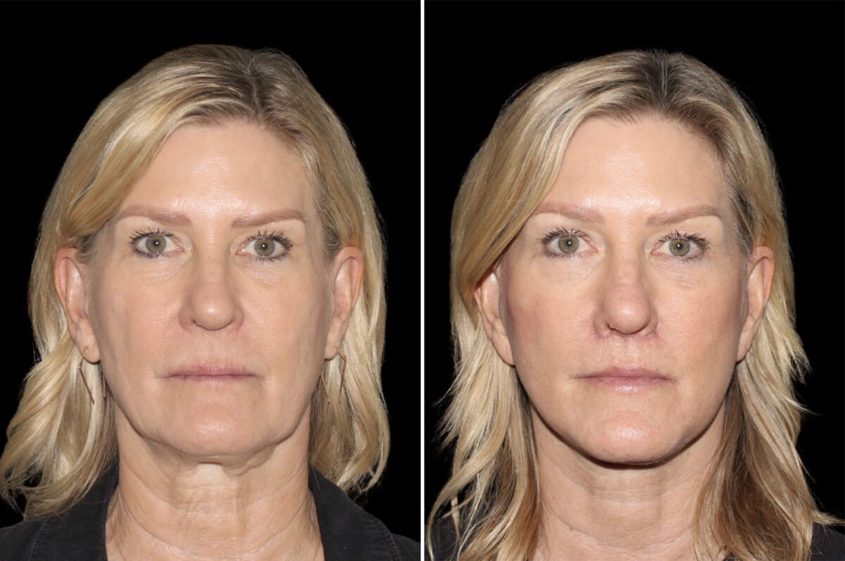 Facelift & Necklift Before and After Photos in CA, Irvine, Patient 5137