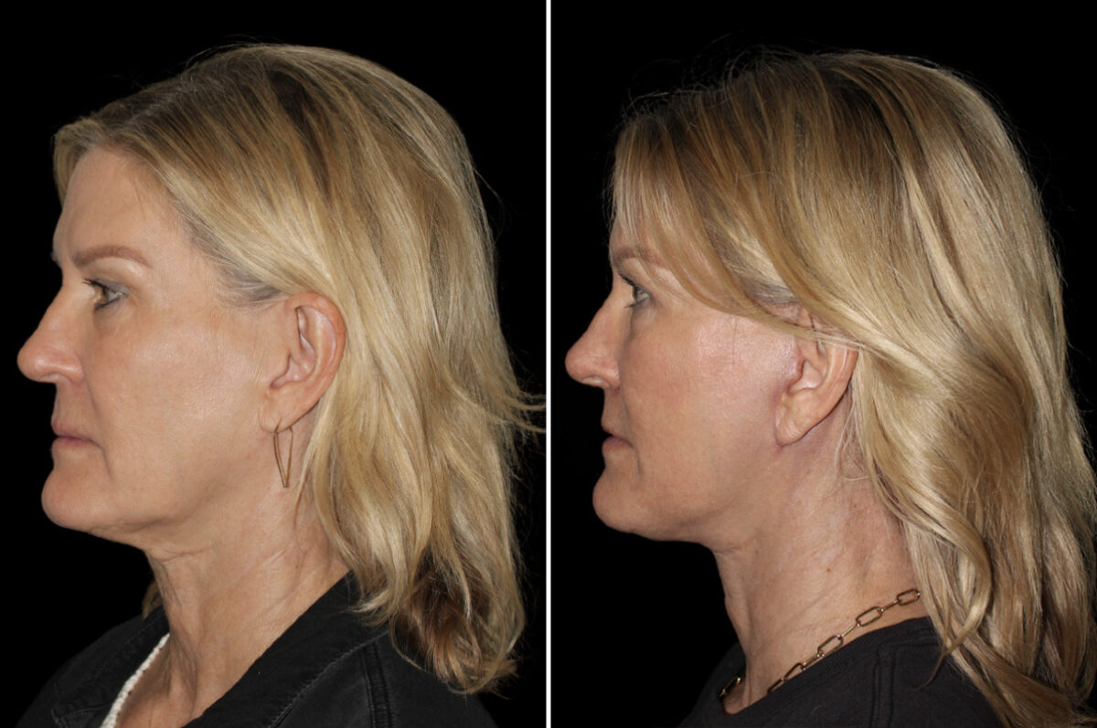 Facelift & Necklift Before and After Photos in CA, Irvine, Patient 5137