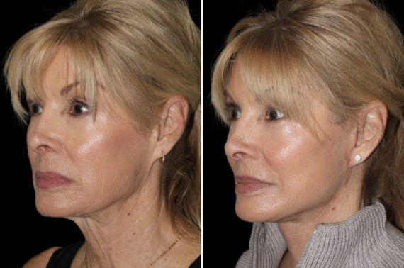 Facelift & Necklift Before and After Photos in CA, Irvine, Patient 5195