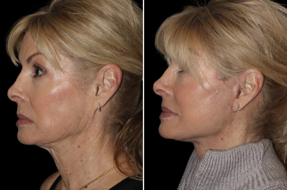 Facelift & Necklift Before and After Photos in CA, Irvine, Patient 5195