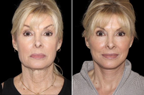 Facelift & Necklift Before and After Photos in CA, Irvine, Patient 5195