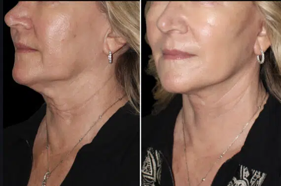Facelift & Necklift Before and After Photos in CA, Irvine, Patient 5199