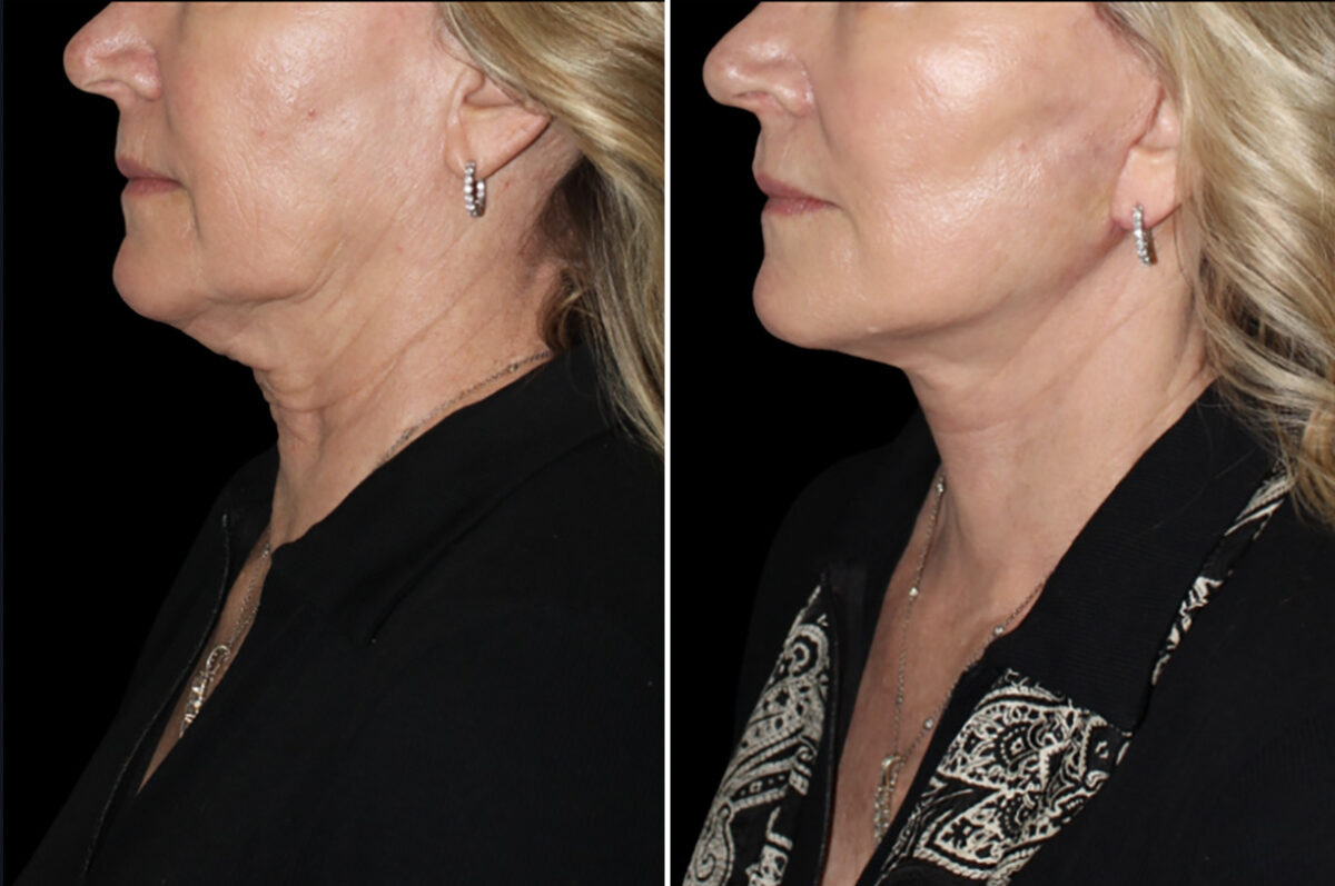 Facelift & Necklift Before and After Photos in CA, Irvine, Patient 5199