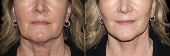 Facelift & Necklift Before and After Photos in CA, Irvine, Patient 5199