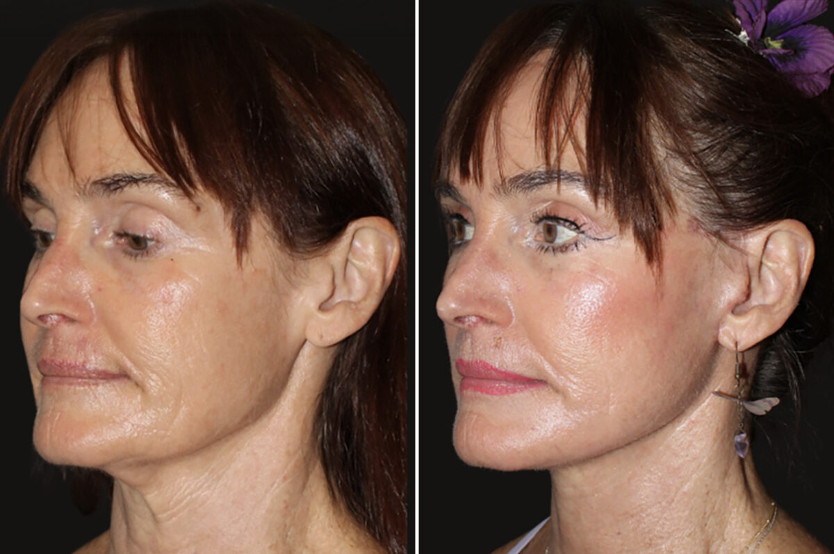 Facelift & Necklift Before and After Photos in CA, Irvine, Patient 5203