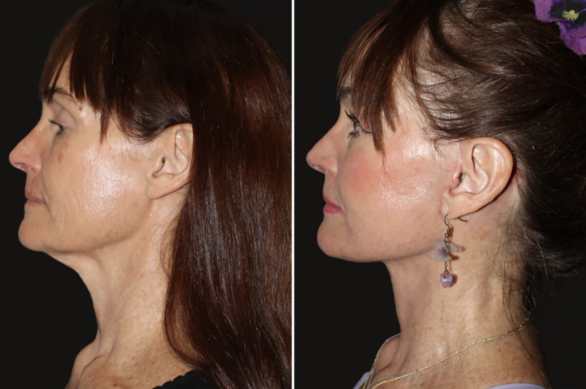 Facelift & Necklift Before and After Photos in CA, Irvine, Patient 5203