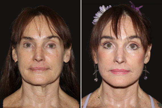 Facelift & Necklift Before and After Photos in CA, Irvine, Patient 5203