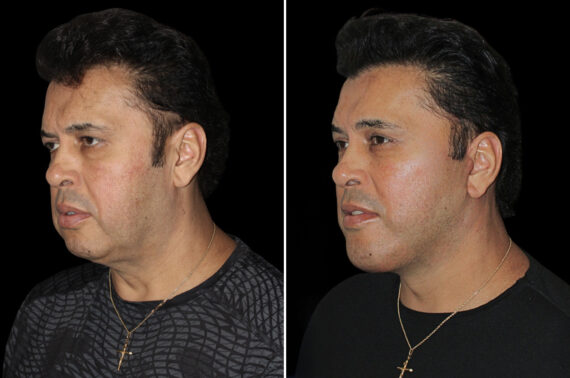 Facelift & Necklift Before and After Photos in CA, Irvine, Patient 5207