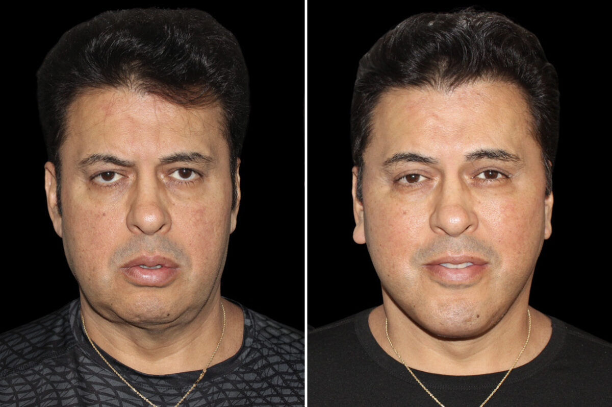 Facelift & Necklift Before and After Photos in CA, Irvine, Patient 5207