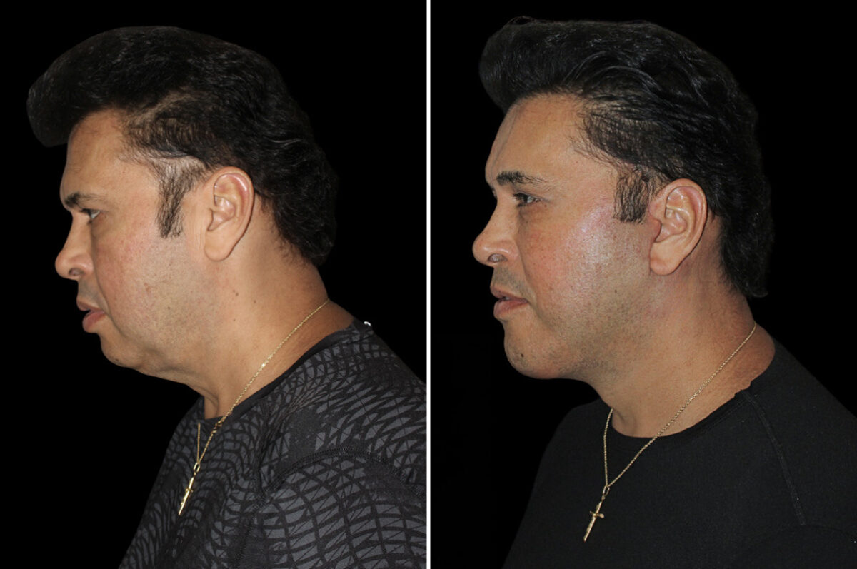 Facelift & Necklift Before and After Photos in CA, Irvine, Patient 5207