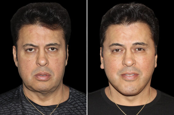 Facelift & Necklift Before and After Photos in CA, Irvine, Patient 5207