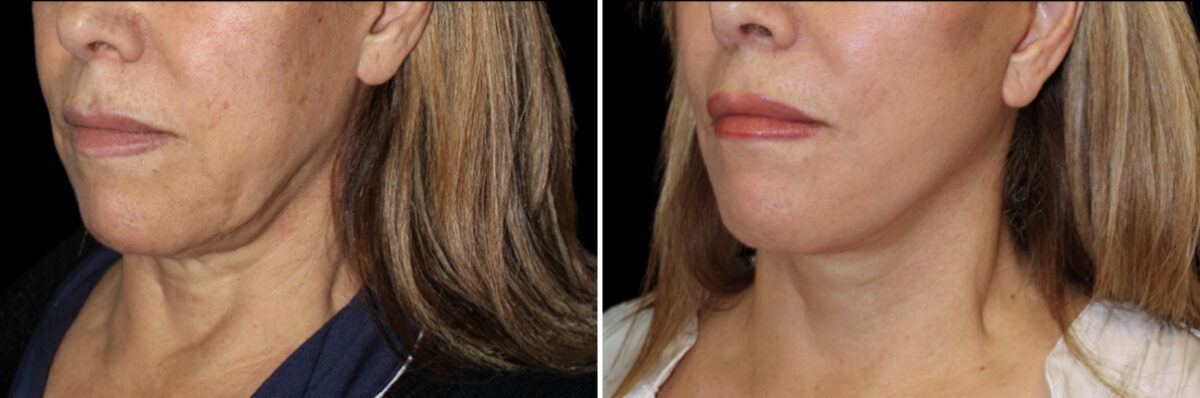 Facelift & Necklift Before and After Photos in CA, Irvine, Patient 5211