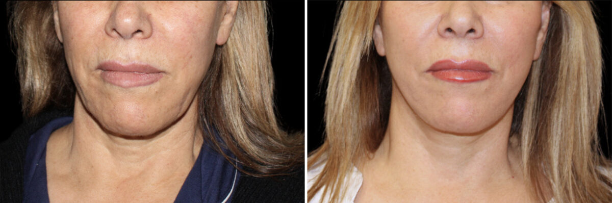 Facelift & Necklift Before and After Photos in CA, Irvine, Patient 5211