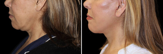 Facelift & Necklift Before and After Photos in CA, Irvine, Patient 5211
