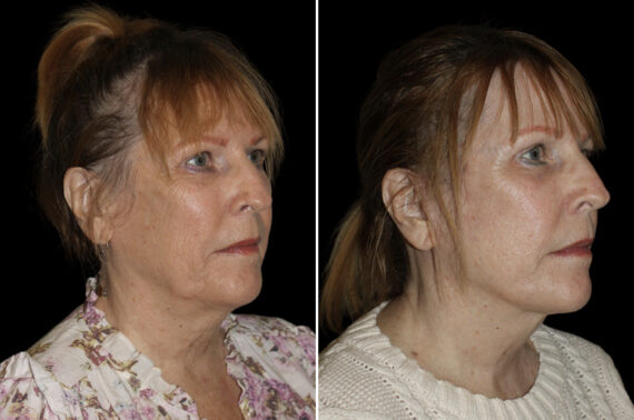 Facelift & Necklift Before and After Photos in CA, Irvine, Patient 5215