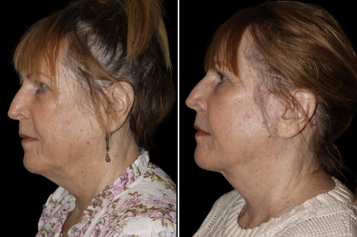 Facelift & Necklift Before and After Photos in CA, Irvine, Patient 5215