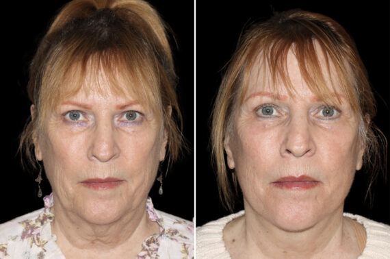 Facelift & Necklift Before and After Photos in CA, Irvine, Patient 5215