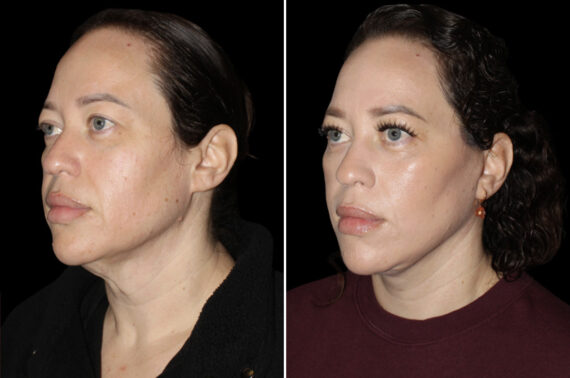 Facelift & Necklift Before and After Photos in CA, Irvine, Patient 5219