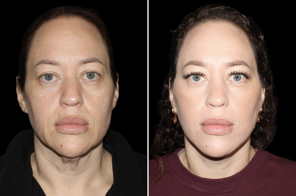 Facelift & Necklift Before and After Photos in CA, Irvine, Patient 5219