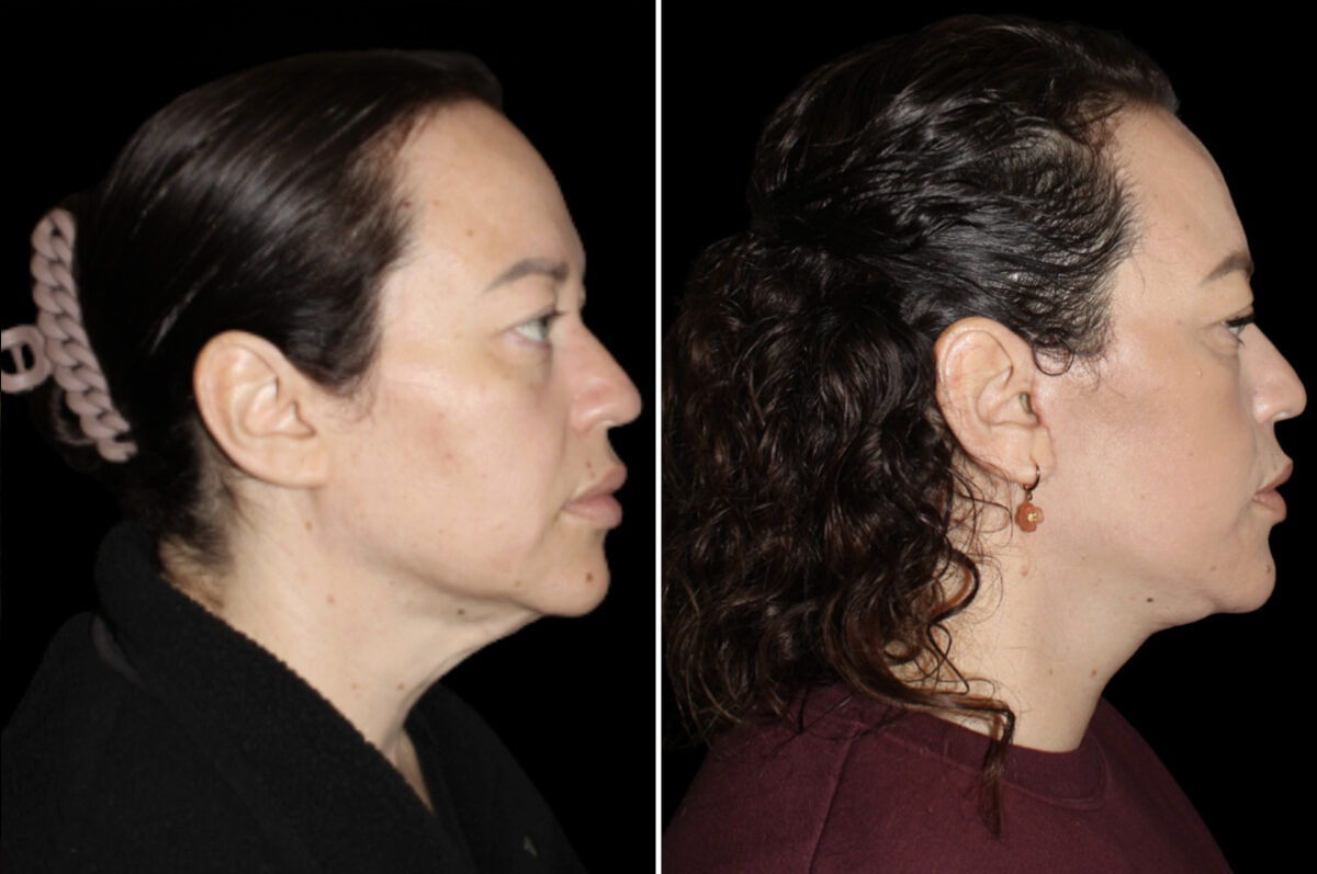 Facelift & Necklift Before and After Photos in CA, Irvine, Patient 5219
