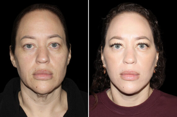 Facelift & Necklift Before and After Photos in CA, Irvine, Patient 5219