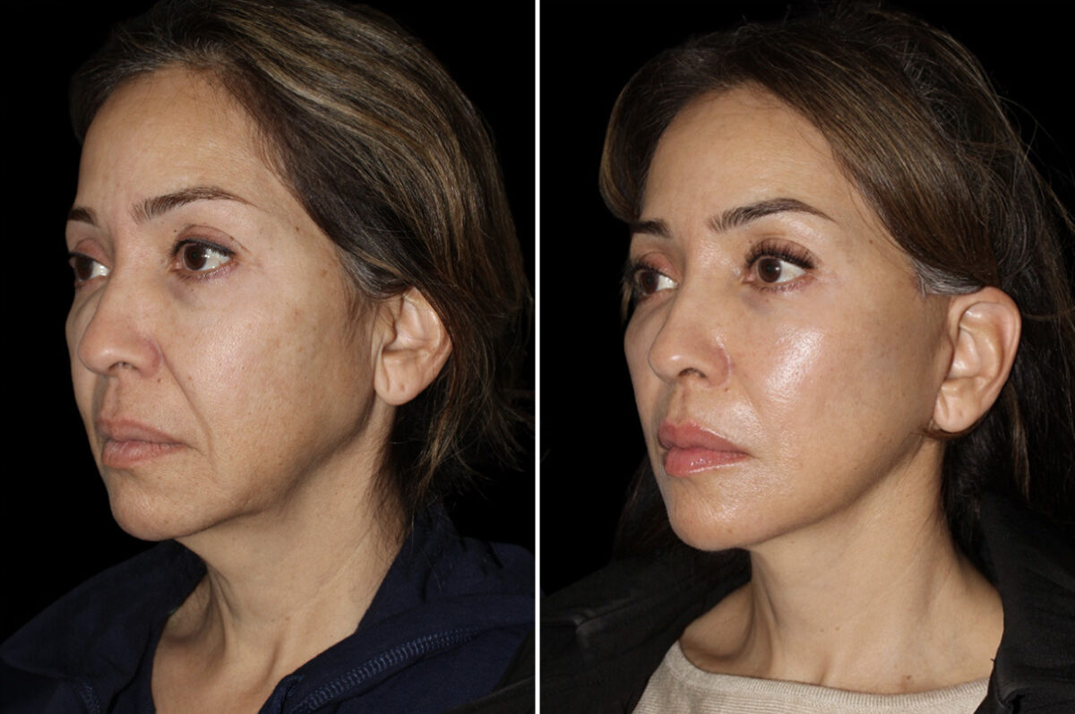 Mini Lift Before and After Photos in CA, Irvine, Patient 5223