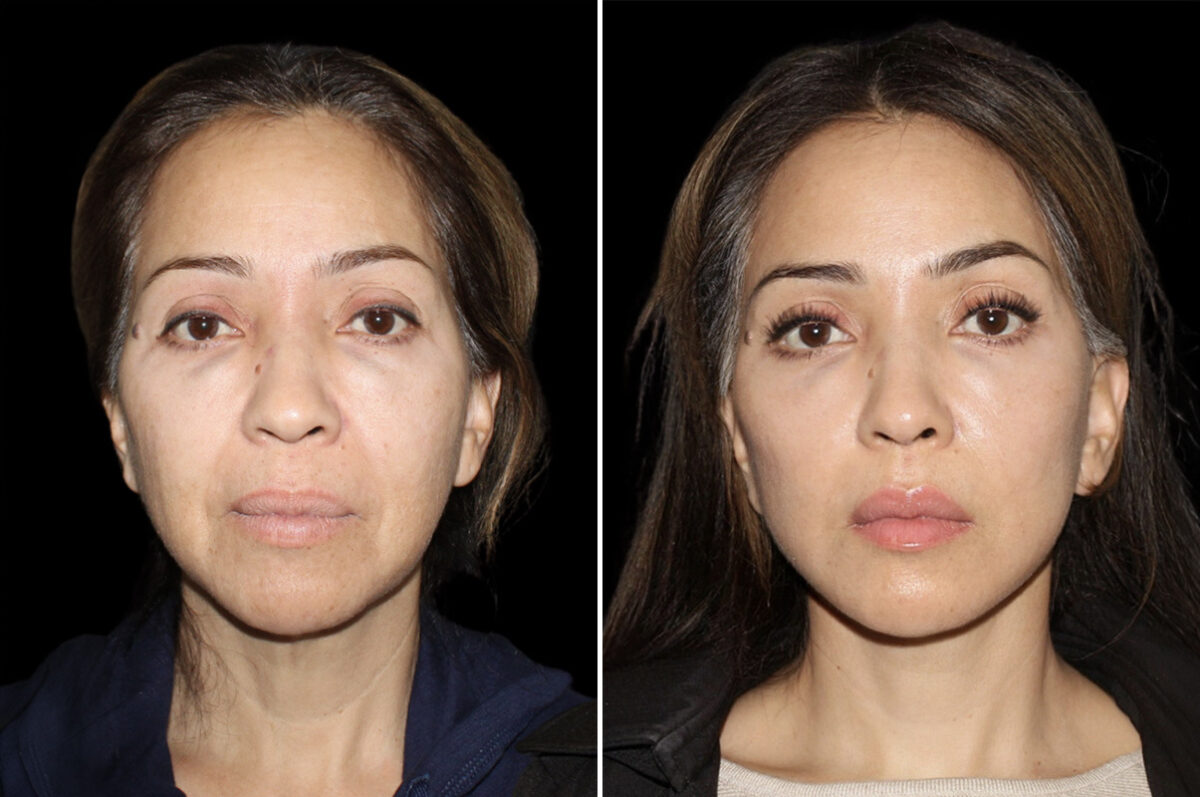 Mini Lift Before and After Photos in CA, Irvine, Patient 5223
