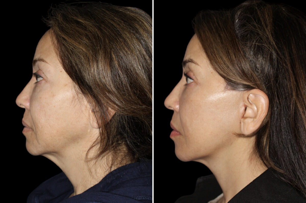 Mini Lift Before and After Photos in CA, Irvine, Patient 5223