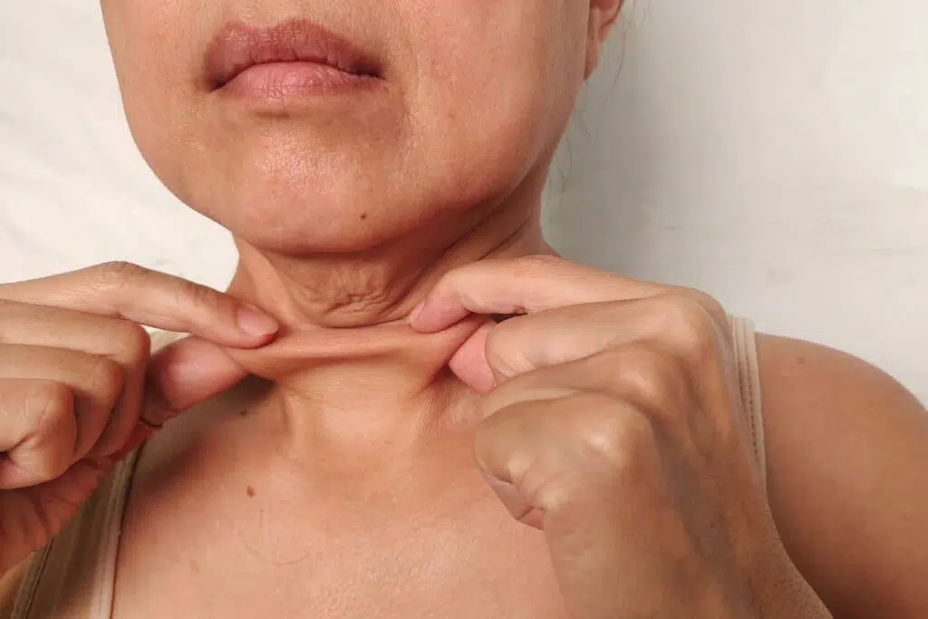 Woman pinching loose neck skin illustrating “Ozempic Neck” and sagging after rapid weight loss.