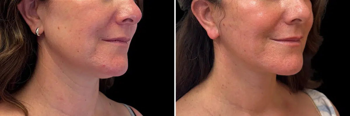 Facelift & Necklift Before and After Photos in CA, Irvine, Patient 5927
