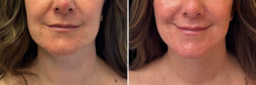 Facelift & Necklift Before and After Photos in CA, Irvine, Patient 5927