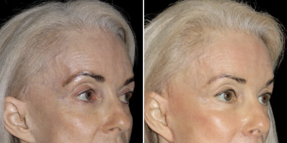 Fat Transfer Before and After Photos in CA, Irvine, Patient 5950