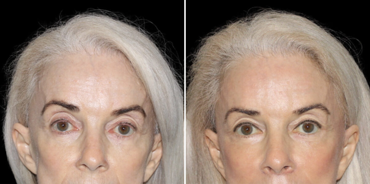 Fat Transfer Before and After Photos in CA, Irvine, Patient 5950