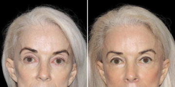 Fat Transfer Before and After Photos in CA, Irvine, Patient 5950