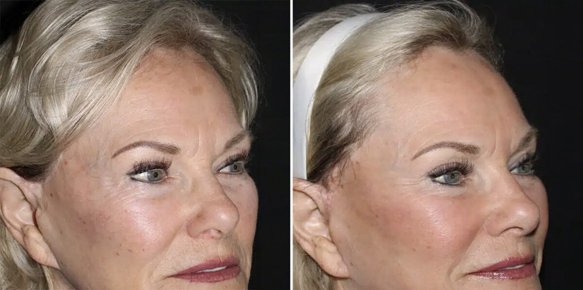 Fat Transfer Before and After Photos in CA, Irvine, Patient 5953
