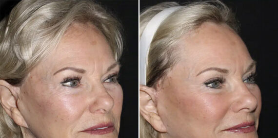 Fat Transfer Before and After Photos in CA, Irvine, Patient 5953