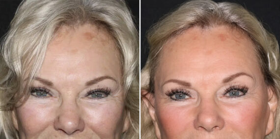 Fat Transfer Before and After Photos in CA, Irvine, Patient 5953