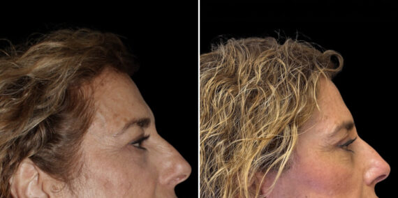 Fat Transfer Before and After Photos in CA, Irvine, Patient 5956