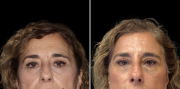 Fat Transfer Before and After Photos in CA, Irvine, Patient 5956